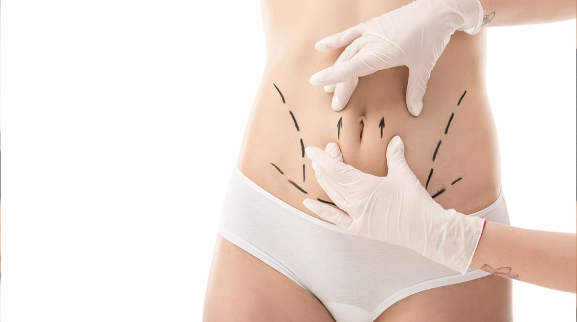 Liposukcja kawitacyjna czy klasyczna? Porównanie metod redukcji tkanki tłuszczowej